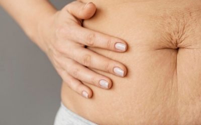 Permanently Get Rid of Stretch Marks after pregnancy